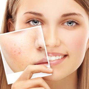 acne tips hollyberry cosmetics