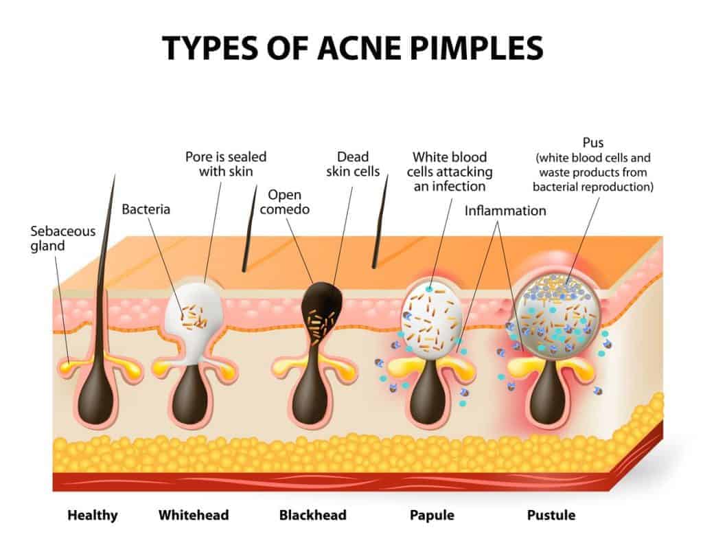 Types of Acne Scars that are most common