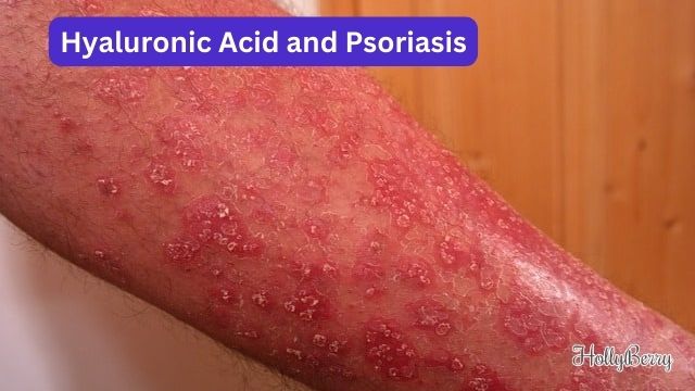 Hyaluronic Acid and Psoriasis
