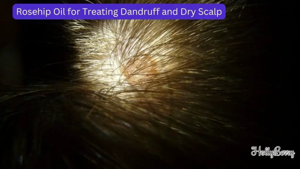 Rosehip Oil for Treating Dandruff and Dry Scalp